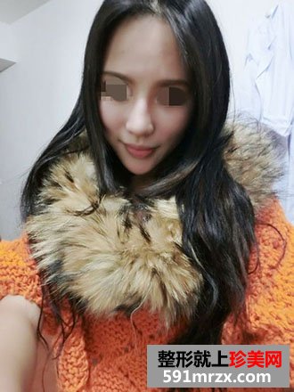 玻尿酸填充苹果机+下巴恢复过程和前后对比照片