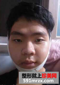 男生面部整形前后效果对比