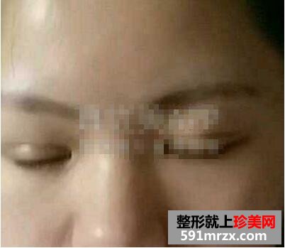 埋线去肿眼泡手术前后对比效果照片和恢复过程真实经历