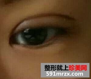 埋线去肿眼泡手术前后对比效果照片和恢复过程真实经历