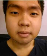 男生面部整形前后效果对比