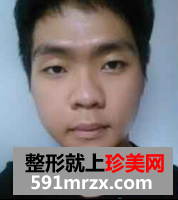 男生面部整形前后效果对比