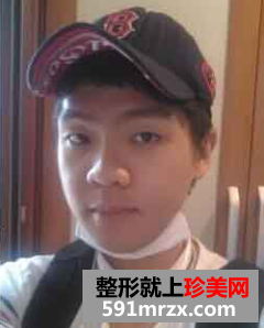 男生面部整形前后效果对比
