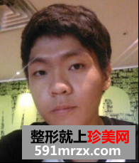 男生面部整形前后效果对比