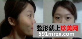 割双眼皮+硅胶隆鼻整形+面部综合整形恢复日记