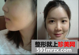 割双眼皮+硅胶隆鼻整形+面部综合整形恢复日记