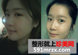 割双眼皮+硅胶隆鼻整形+面部综合整形恢复日记