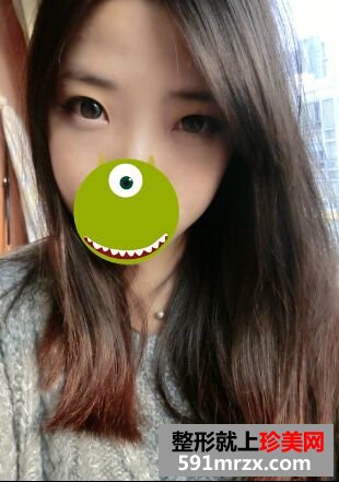 做完双眼皮手术消肿挺快，恢复不错~