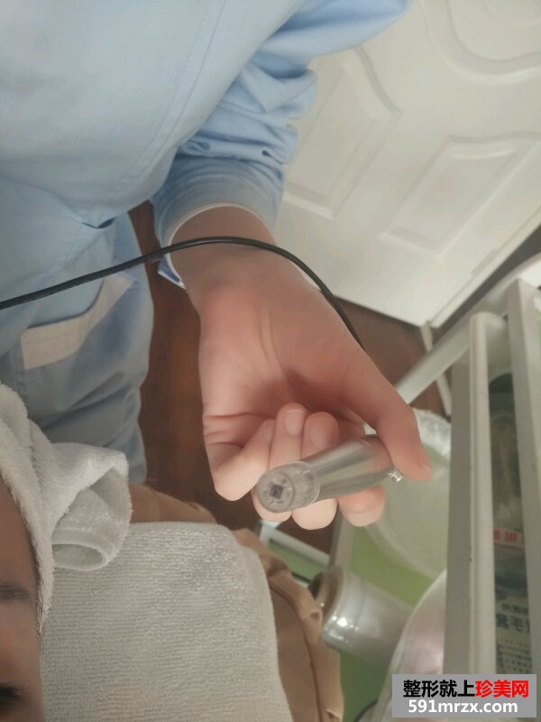 微晶磨皮手术去红血丝祛痘前后对比效果图片跟恢复过程分享