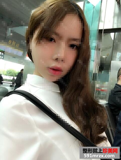 微晶磨皮手术去红血丝祛痘前后对比效果图片跟恢复过程分享
