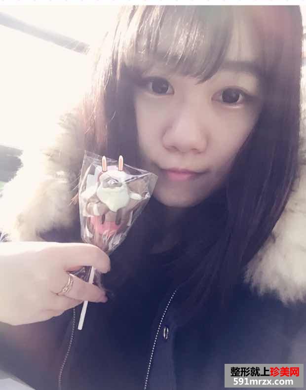 注射玻尿酸隆鼻前后对比效果照片与手术恢复过程分享