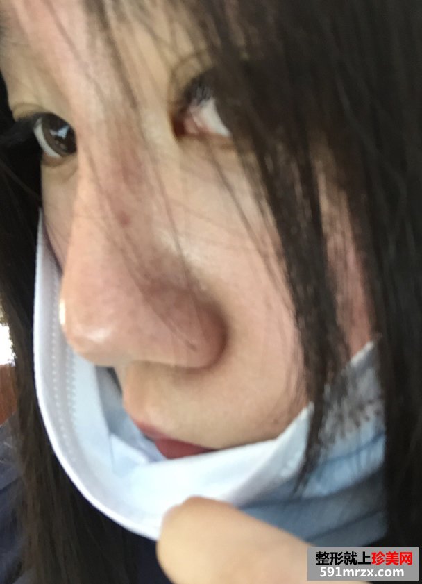 注射玻尿酸隆鼻前后对比效果照片与手术恢复过程分享