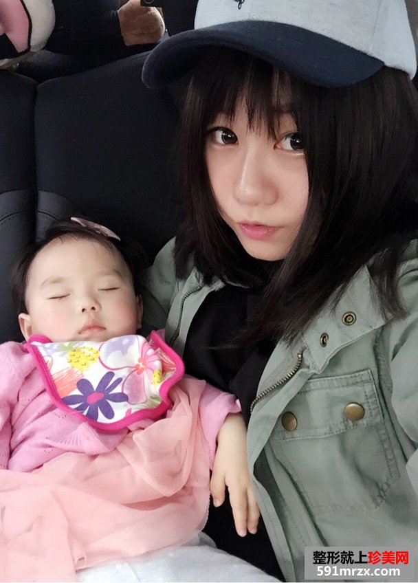 注射玻尿酸隆鼻前后对比效果照片与手术恢复过程分享