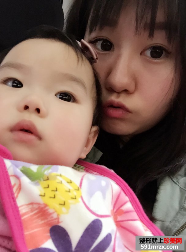 注射玻尿酸隆鼻前后对比效果照片与手术恢复过程分享