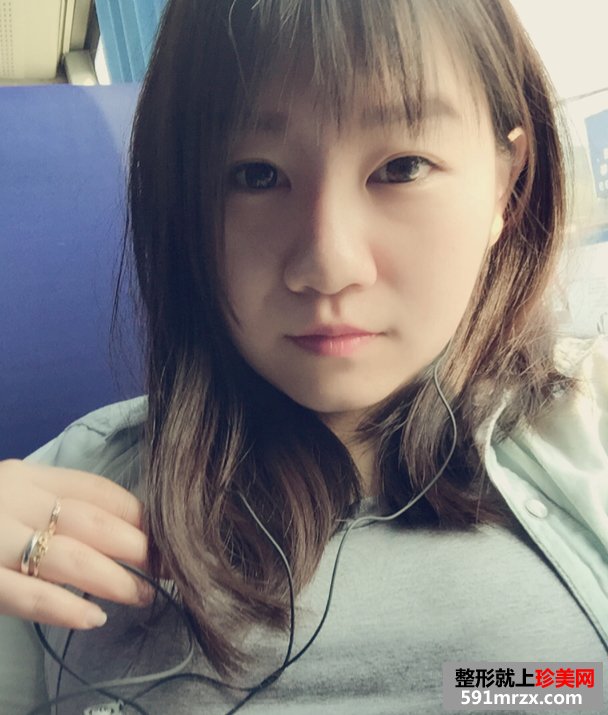 注射玻尿酸隆鼻前后对比效果照片与手术恢复过程分享