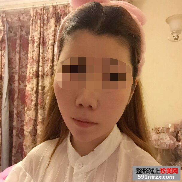 美女botox注射瘦脸手术恢复过程分享，还有前后对比效果图片哦！