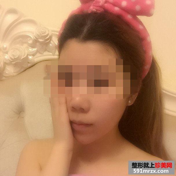 美女botox注射瘦脸手术恢复过程分享，还有前后对比效果图片哦！