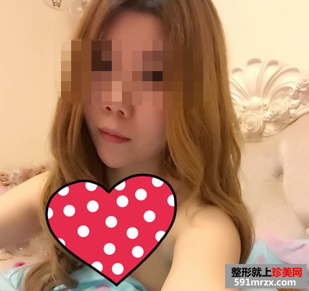美女botox注射瘦脸手术恢复过程分享，还有前后对比效果图片哦！