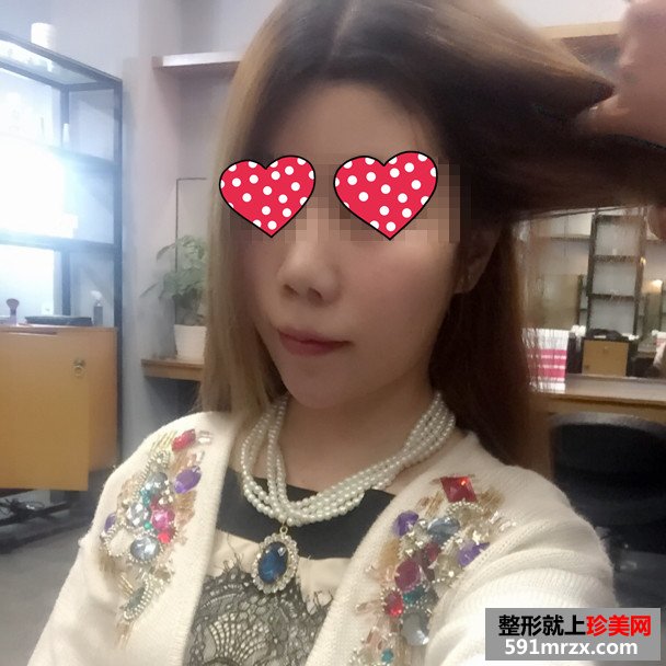 美女botox注射瘦脸手术恢复过程分享，还有前后对比效果图片哦！