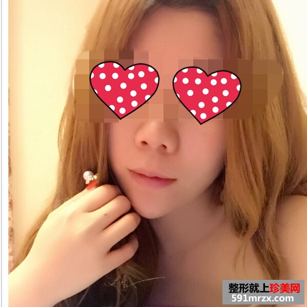 美女botox注射瘦脸手术恢复过程分享，还有前后对比效果图片哦！
