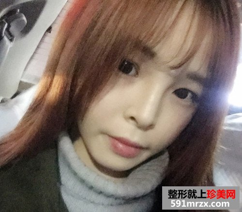 玻尿酸注射隆鼻垫下巴手术前后效果对比照片和恢复过程分享