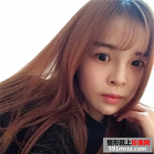 玻尿酸注射隆鼻垫下巴手术前后效果对比照片和恢复过程分享
