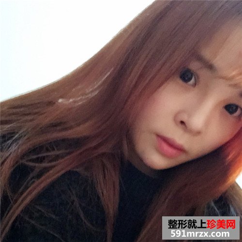 玻尿酸注射隆鼻垫下巴手术前后效果对比照片和恢复过程分享
