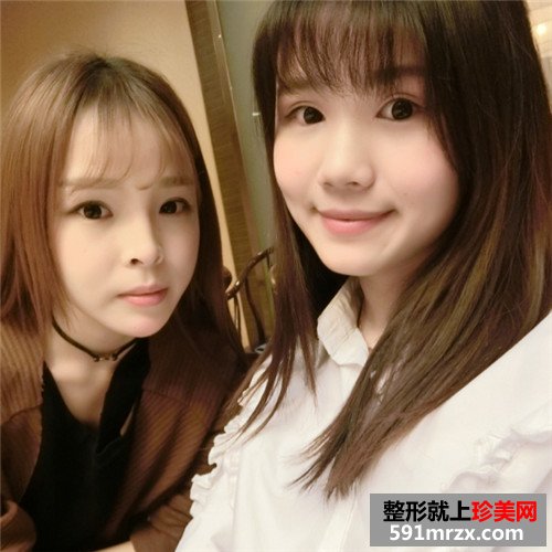 玻尿酸注射隆鼻垫下巴手术前后效果对比照片和恢复过程分享