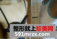北京八大处假体隆胸恢复过程分享