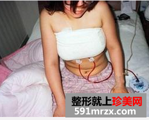 北京八大处假体隆胸恢复过程分享