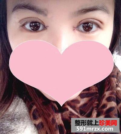 北京史三八整形做的切开割双眼皮+开内眼角，有前后对比效果图片分享