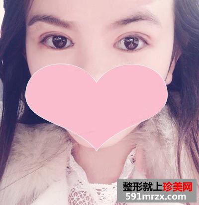 北京史三八整形做的切开割双眼皮+开内眼角，有前后对比效果图片分享