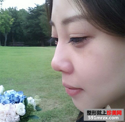美女童颜针丰额头手术恢复过程真实案例，还有前后对比效果图片