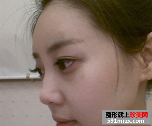 美女童颜针丰额头手术恢复过程真实案例，还有前后对比效果图片