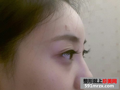 美女童颜针丰额头手术恢复过程真实案例，还有前后对比效果图片