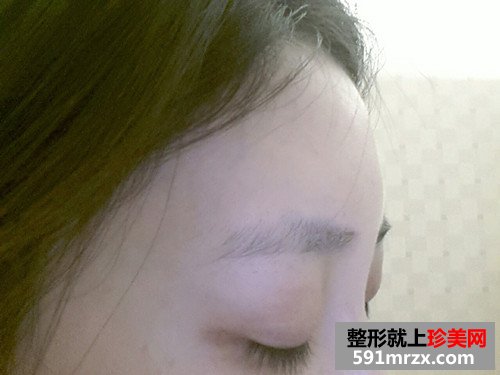 美女童颜针丰额头手术恢复过程真实案例，还有前后对比效果图片