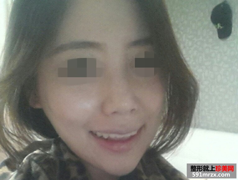 美女童颜针丰额头手术恢复过程真实案例，还有前后对比效果图片