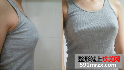 北京知音假体隆胸前后对比照