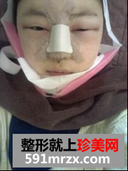 北京新星靓面部整形+隆鼻修复前后对比图