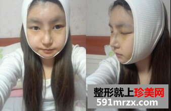 北京新星靓面部整形+隆鼻修复前后对比图