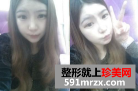 北京新星靓面部整形+隆鼻修复前后对比图