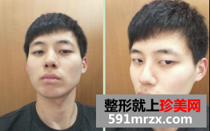 面部综合整形+软骨隆鼻3个月恢复纪实