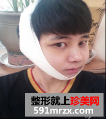 面部综合整形+软骨隆鼻3个月恢复纪实