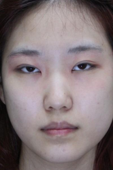 隆鼻割双眼皮多久恢复 北京东方瑞丽割双眼皮+硅胶隆鼻归来