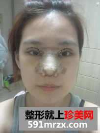 隆鼻割双眼皮多久恢复 北京东方瑞丽割双眼皮+硅胶隆鼻归来