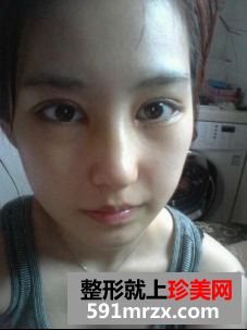 隆鼻割双眼皮多久恢复 北京东方瑞丽割双眼皮+硅胶隆鼻归来