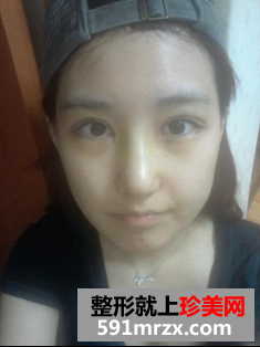 隆鼻割双眼皮多久恢复 北京东方瑞丽割双眼皮+硅胶隆鼻归来