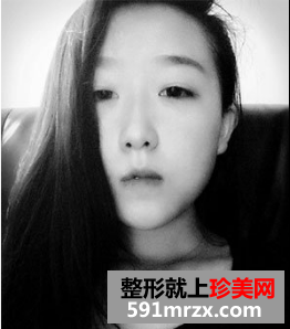 割双眼皮多久恢复自然 北京京美割双眼皮案例