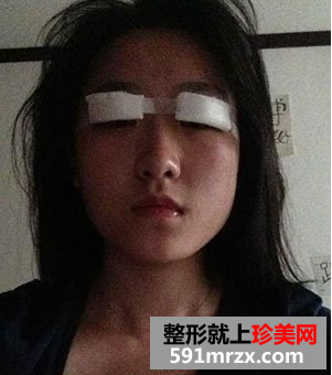 割双眼皮多久恢复自然 北京京美割双眼皮案例