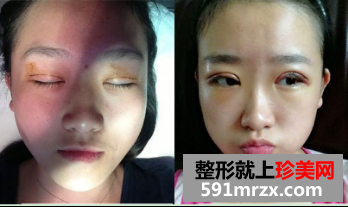 割双眼皮多久恢复自然 北京京美割双眼皮案例